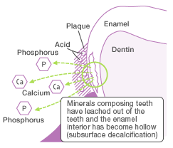 Minerals composing teeth have leached out of the teeth and the enamel interior has become hollow (subsurface decalcification)