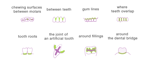 Areas Susceptible to Caries (chewing surfaces between molars, between teeth, gum lines, where teeth overlap, tooth roots, where a denture is used, the joint of an artificial tooth, around fillings, around a crown, around the dental bridge, etc.)
