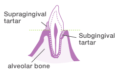 Among the forms of tartar, there is supragingival tartar, which forms above the gums, and subgingival tartar, which forms between the enamel and gums.