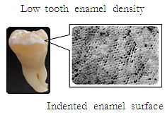 Low tooth enamel density ,Indented enamel surface