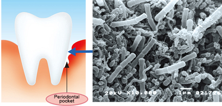 Periodontal Disease Destroys Periodontal Tissue, Leading to Tooth Loss