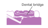 Use an interdental brush under prosthetic teeth