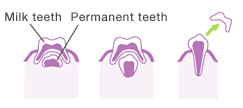 When the cells that break down the tissue appear around the roots of the milk teeth, the roots gradually dissolve and are absorbed, becoming shorter. When the permanent teeth become large enough, the milk teeth naturally start to fall out and are replaced by the permanent teeth.