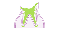 C4 (caries leaving only the tooth roots)