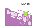 If the tip of the root of a tooth that is badly affected by caries becomes filled with pus, it may affect the permanent tooth just below.