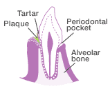 At the stage of gingivitis, plaque has accumulated between the enamel and gums. The gums appear red-tinged, and the tips of the gums between teeth are rounded and plump.