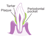 At the stage of periodontitis, tartar and plaque accumulate between the enamel and gums, and the periodontal pockets have deepened.The gums appear red-purple and flabby, and are starting to recess.