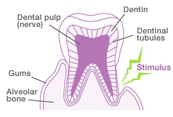 When the dentinal tubules are exposed and stimuli such as temperature or toothbrush bristles are applied, the symptoms of hypersensitivity occur, which include pain in an advanced case.