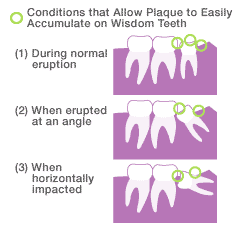 Pay attention to areas between the wisdom teeth and adjoining teeth or between the wisdom teeth and the gums.