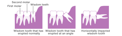 The upper wisdom teeth and lower wisdom teeth engage correctly with each other in some cases while, in other cases, they only erupt halfway and come out at an angle or horizontally impacted in the jaw.